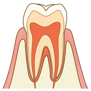 cavity007