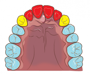 歯の色分け-2
