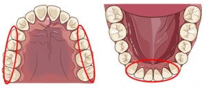 歯石つきやすい部位
